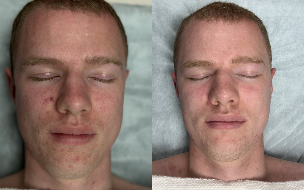 CARELIKA Anti-Acne Project before and after: male client with acne-prone skin