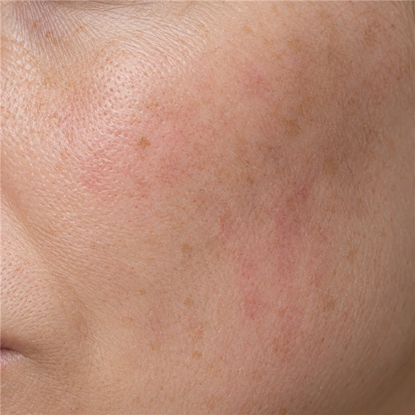 Uneven skin tone