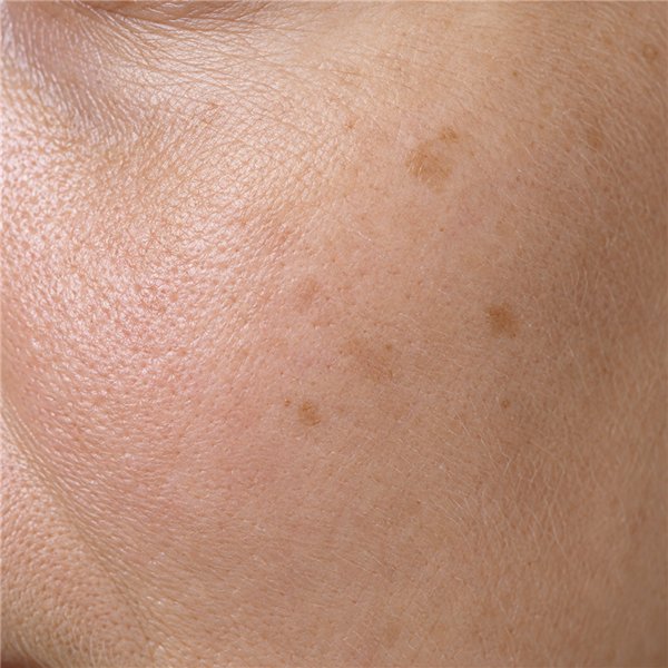 Early pigmentation