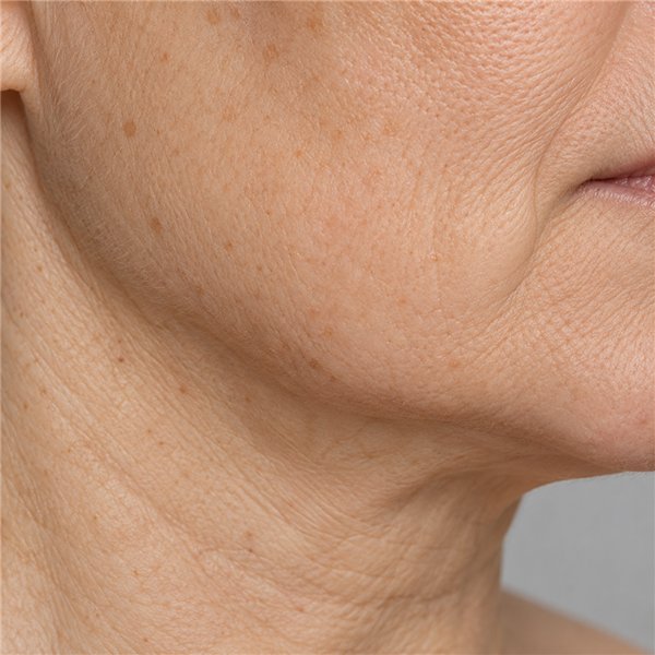 Ādas izmaiņas menopauzē