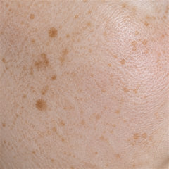 Uneven skin tone and dark spots, macro