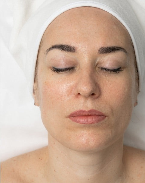 Facial skin after a course of Amber Carboxy Therapy treatments