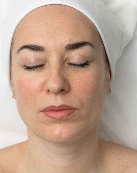 Facial skin before treatment