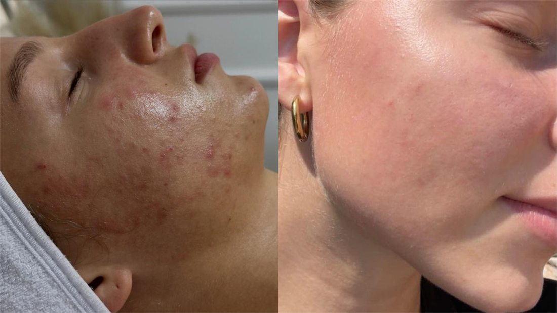 Oily skin with inflammatory elements: before and after a course