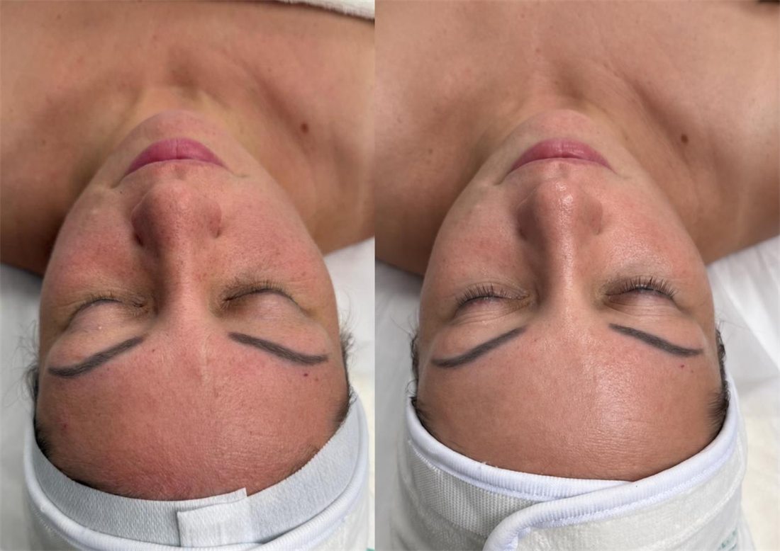 Uneven tone and persistent redness: before and after