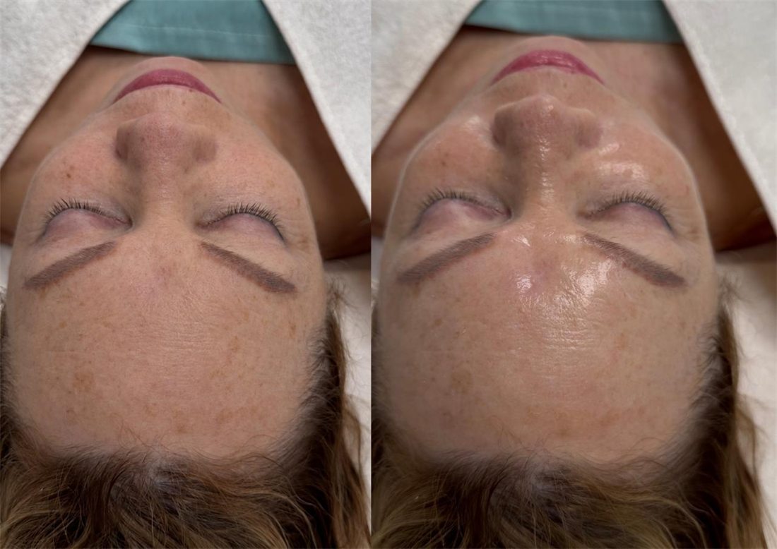 Dull skin and uneven texture: before and after