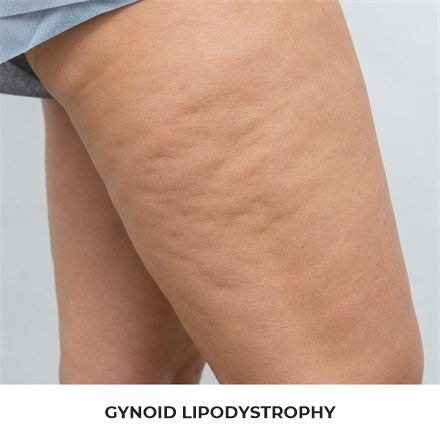 Gynoid lipodystrophy