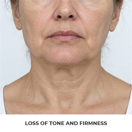 Loss of tone and firmness