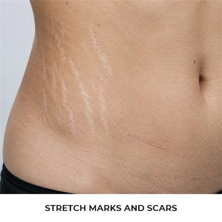 Stretch marks and scars