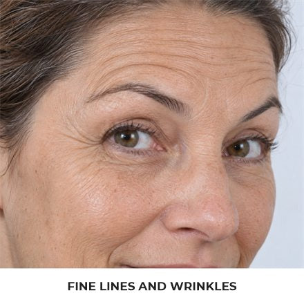 Fine lines and wrinkles