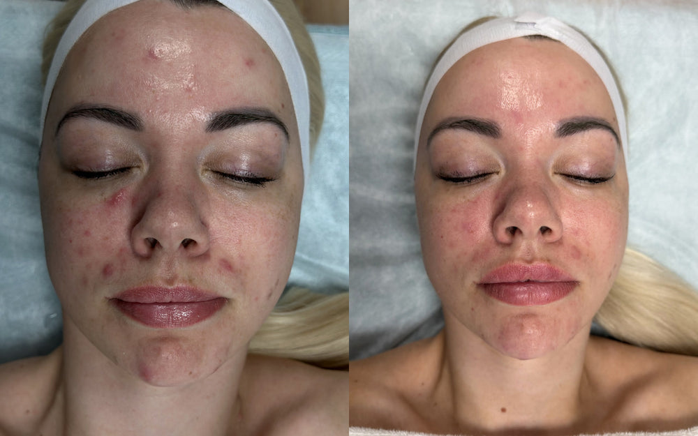 CARELIKA Anti-Acne Project before and after: female client with inflamed acne