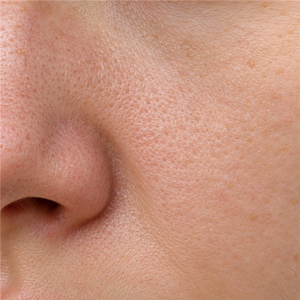 Enlarged pores, uneven texture