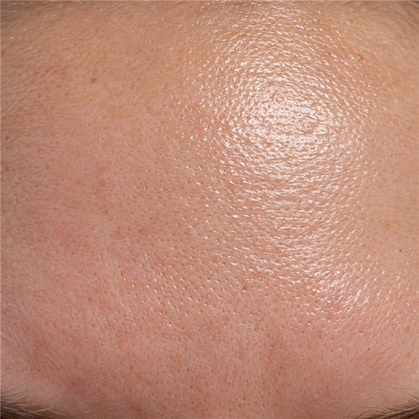 Excess sebum and shine