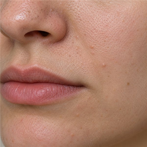 Congested, blemish-prone skin