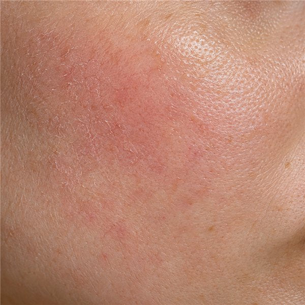 Weakened skin barrier