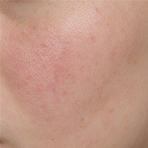 Sensitive, reactive skin