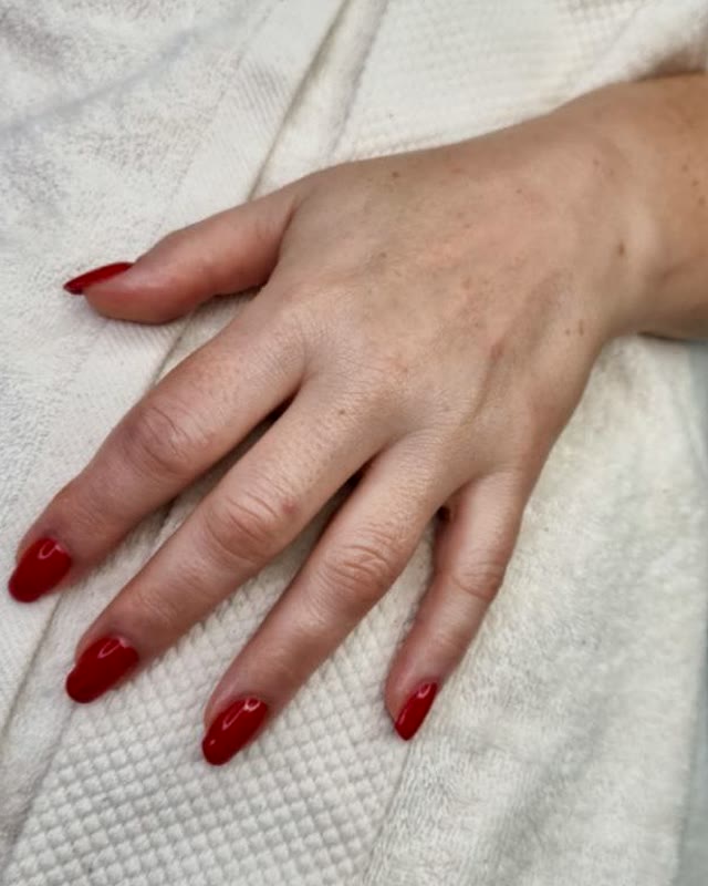 Hands after CARELIKA Carboxy Therapy