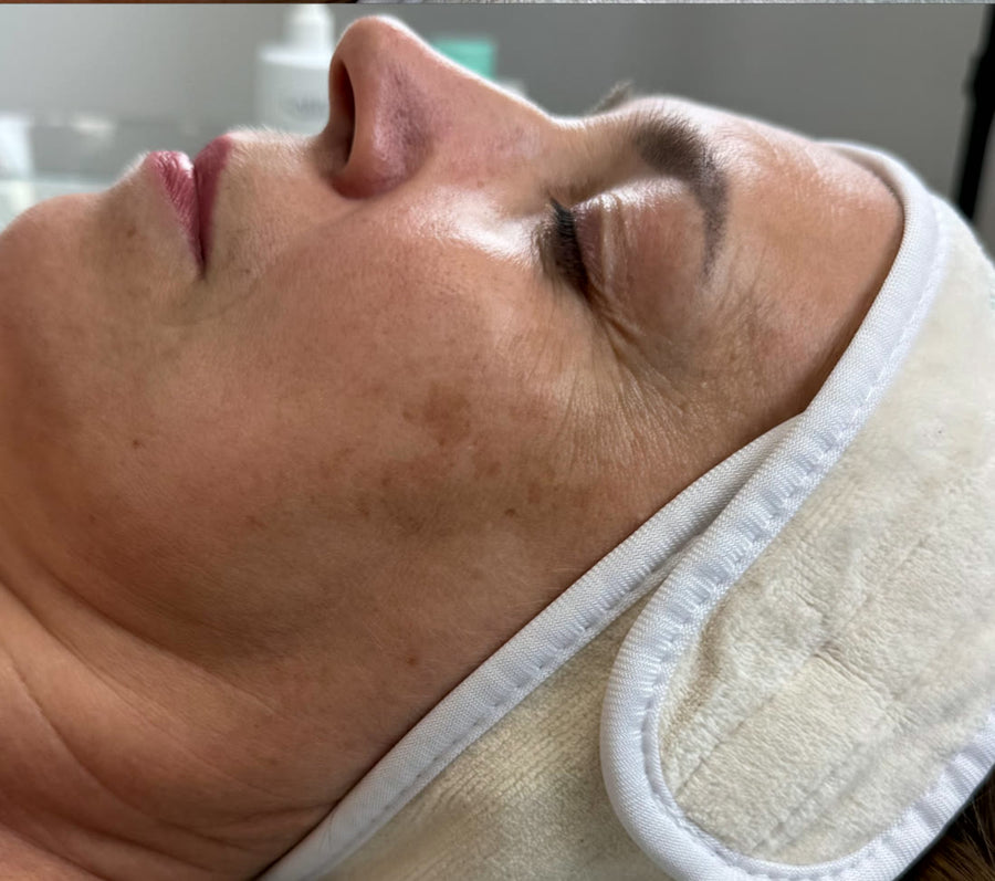 After 1 treatment with CARELIKA TXG Complex