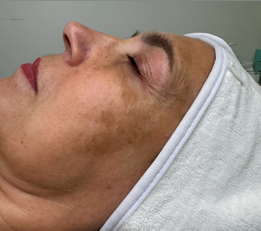 Before: pigmentation on the cheek