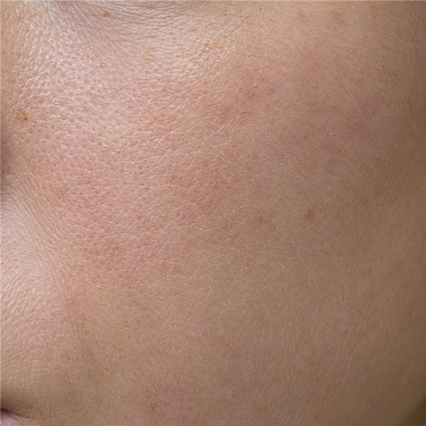 Dehydrated skin