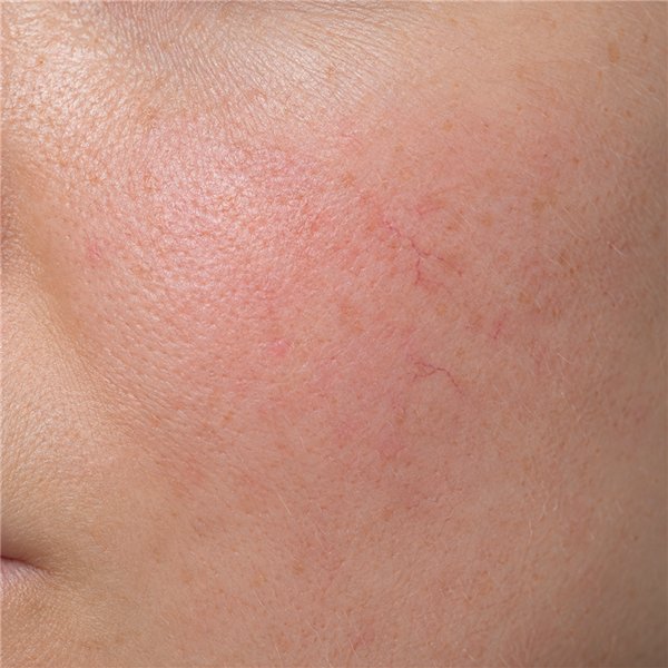 Sensitive, reactive skin