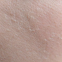 Dry skin, macro